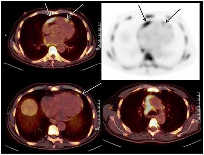 Case report: CAR-T cell therapy-induced cardiac tamponade